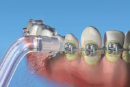 Cómo limpiase con frenos dentales