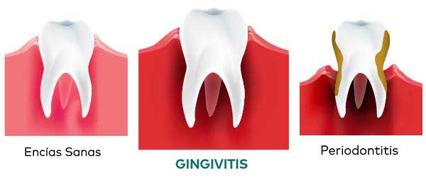 Tratamiento, síntomas y causas de la gingivitis