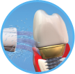 Limpieza y uso del irrigador en implantes dentales