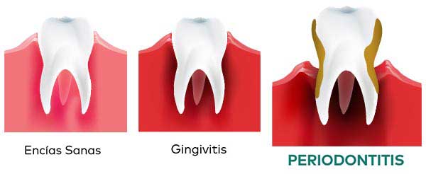 Periodontitis - tratamiento, síntomas y causas